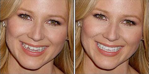 pics of jewel|jewel teeth before and after.